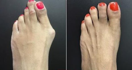 Orthopedic Toe Bunion Corrector For Pain Relief And Toe Alignment - Image 9