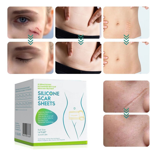 Silicone Scar Tape Roll For Improved Appearance Texture And Size Of Scars - Image 1