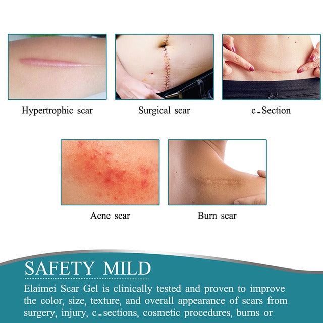 Silicone Scar Tape Roll For Improved Appearance Texture And Size Of Scars - Image 2